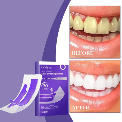 7 PCS Teeth Whitening Strips – Teeth Bleaching Stickers for Removing Yellow Stains