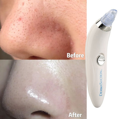 Remove blackheads and impurities without squeezing with DermaSuction